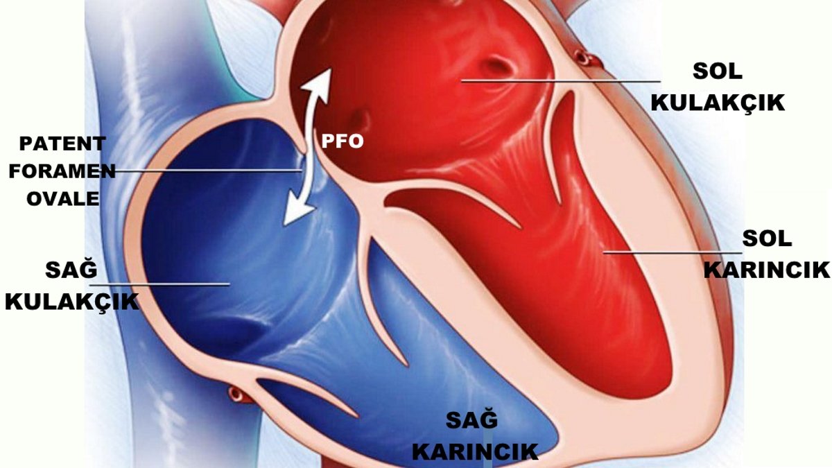 Pfo Pathophysiology 1.(6) Patent Foramen Ovale (PFO) – DOÇ. DR. VEYSEL OZAN TANIK